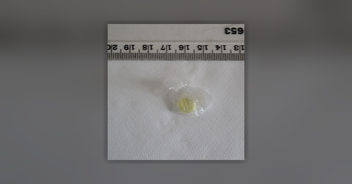 Diazepam
