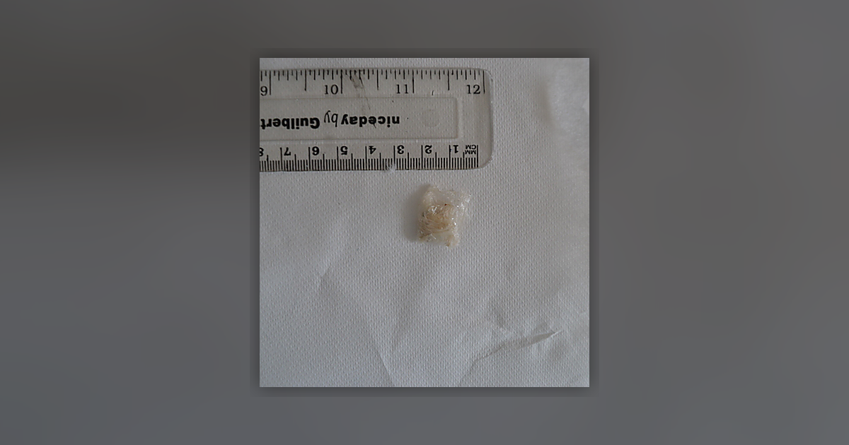 Cocaine; Benzoylecgonine; Norcocaine; Paracetamol; Tropacocaine