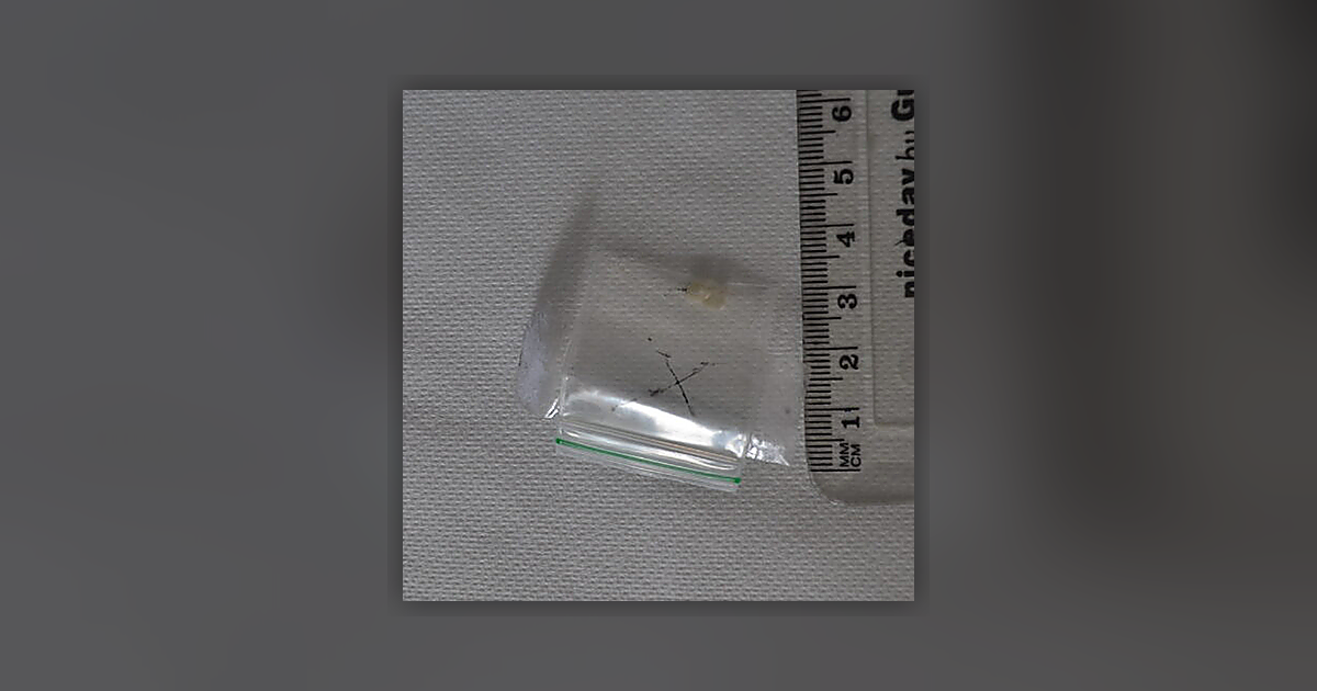 Cocaine; Benzoylecgonine; Ecgonine methyl ester
